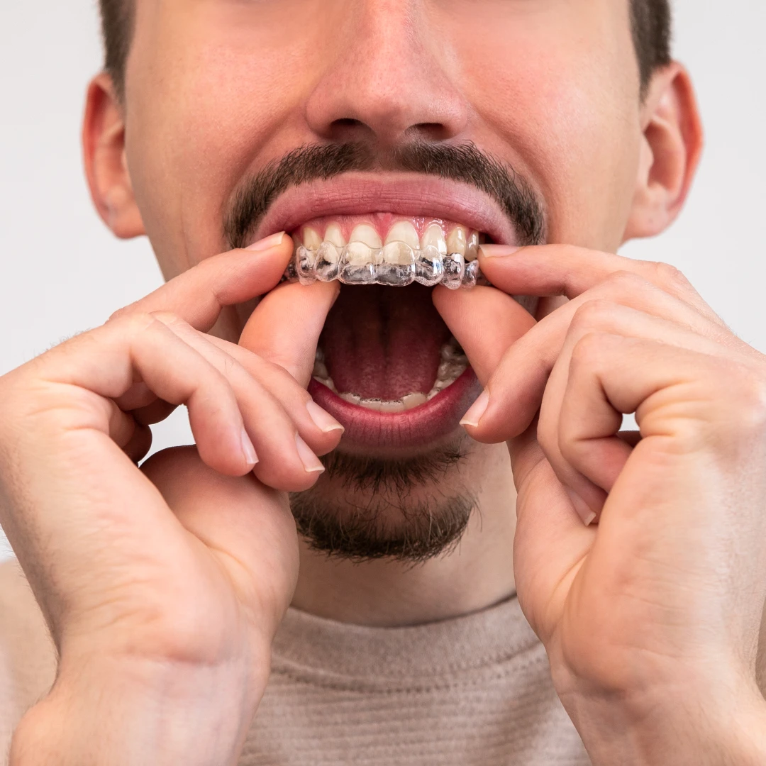 man putting on invisalign clear aligners | best invisalign dentist near you