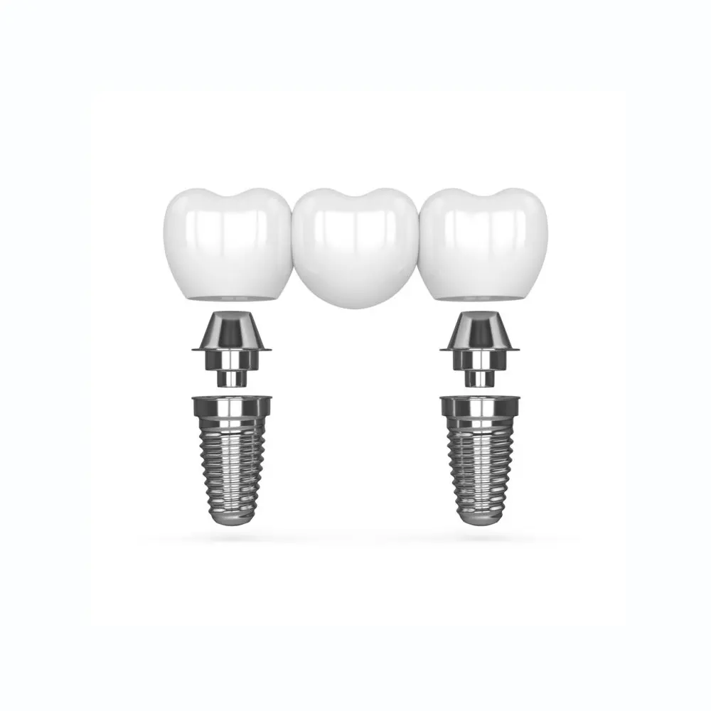 multi-tooth dental implant bridge