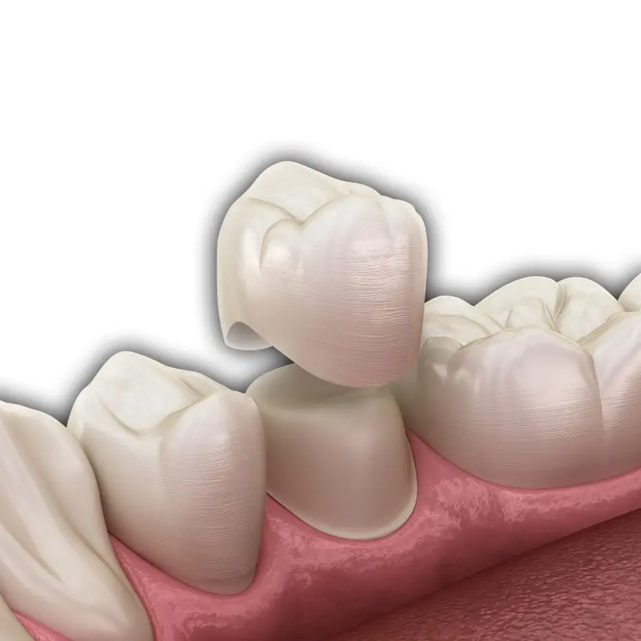 graphic of a dental crown